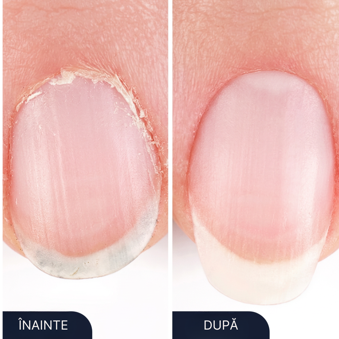 NailCare Pro – Tratament Antifungic pentru Unghii